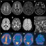 L’eterna veglia che distrugge il cervello: la speranza nasce dalla ricerca trevigiana