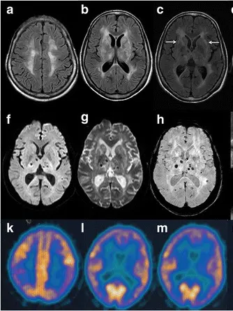 L’eterna veglia che distrugge il cervello: la speranza nasce dalla ricerca trevigiana
