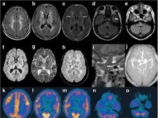 L’eterna veglia che distrugge il cervello: la speranza nasce dalla ricerca trevigiana