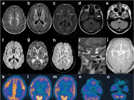L’eterna veglia che distrugge il cervello: la speranza nasce dalla ricerca trevigiana