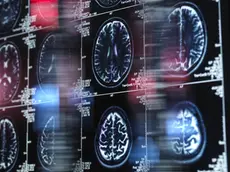 Le immagini della risonanza magnetica di un cervello