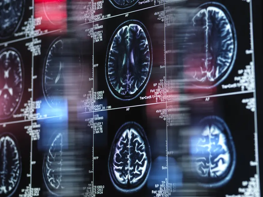 Le immagini della risonanza magnetica di un cervello
