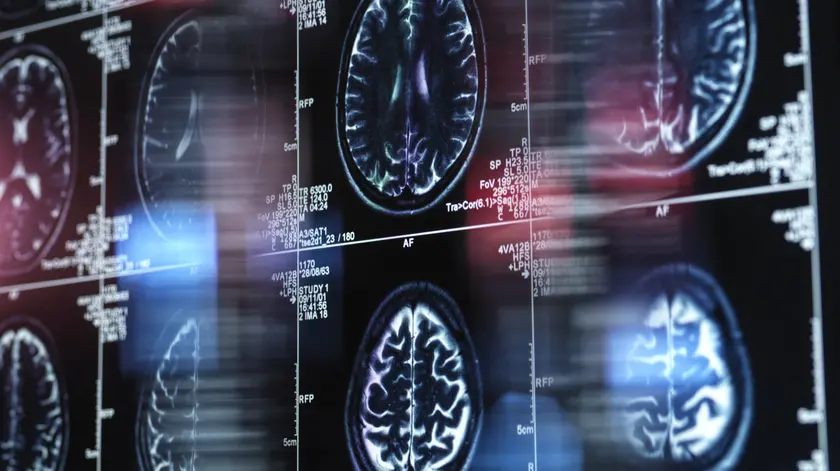 Una risonanza magnetica nella ricerca sull'Alzheimer